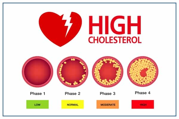 Is there any alternative to statin for high cholesterol? Bempodoic acid passed the test 